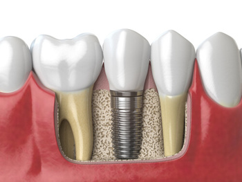 Titanium Teeth Implants material