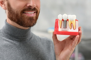 are dental implants safe risks