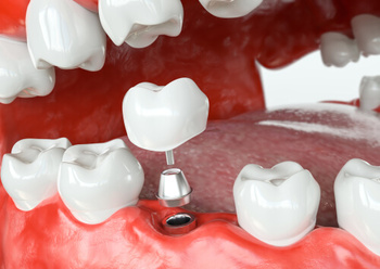 dental implant cost factors